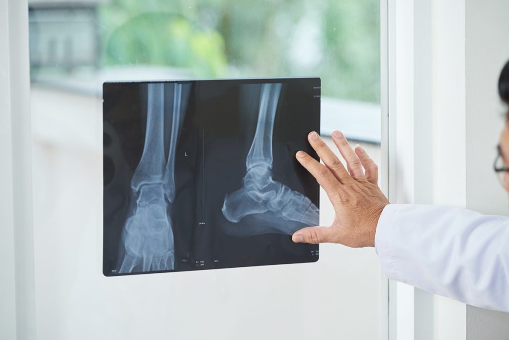 Ankle Replacement Surgery Versus Ankle Fusion Ankle Replacement Surgery Versus Ankle Fusion