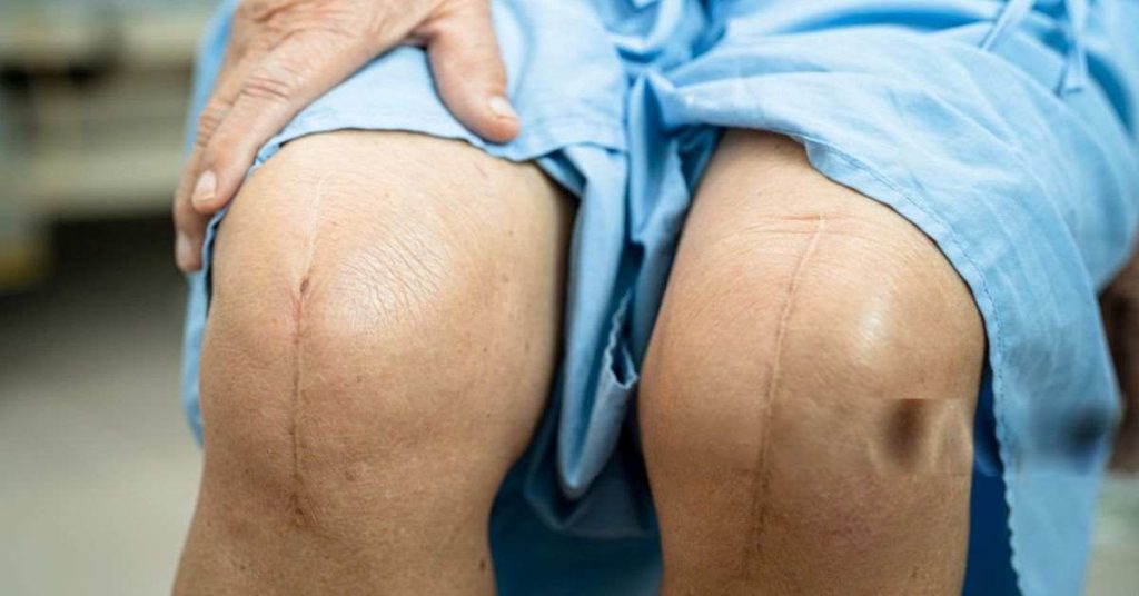 Benefits of Knee Surgery