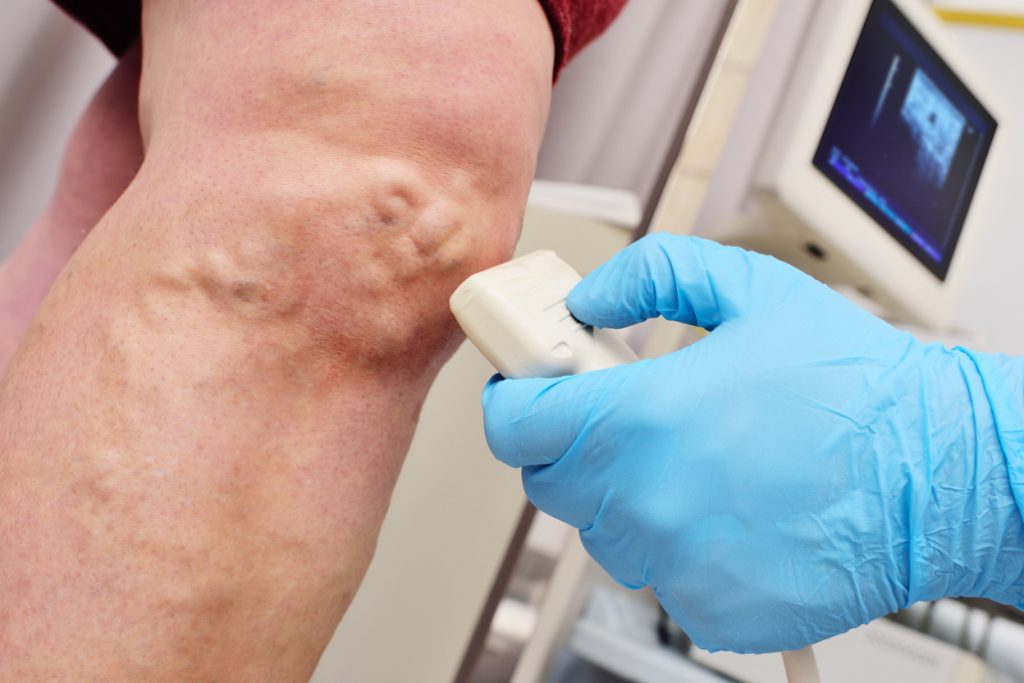 What To Expect From a Consultation With a Vein Surgeon Consultation With a Vein Surgeon