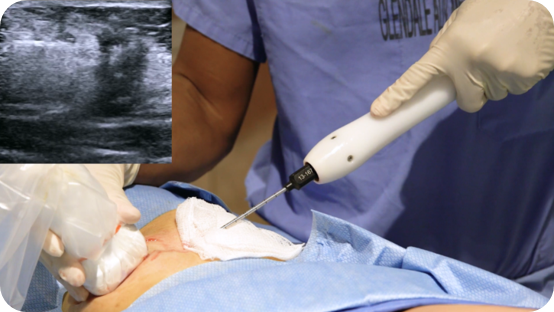 The Use of Cryoablation in Palliative Care Settings Cryoablation in Palliative Care Settings