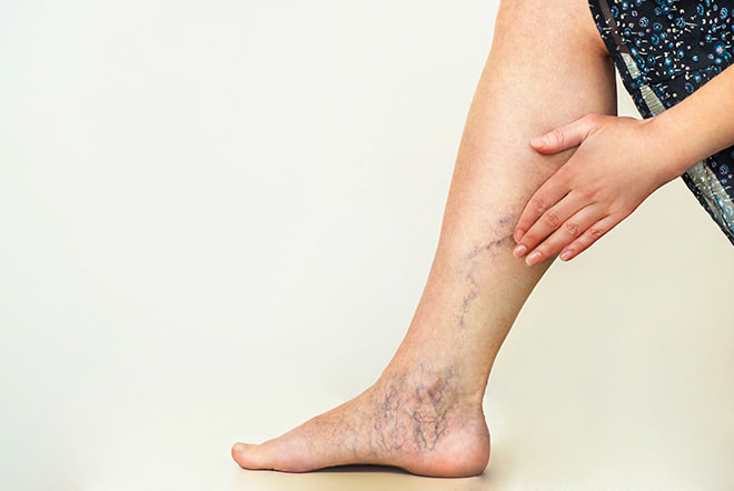 Preventing and Treating Varicose Veins: What You Should Know Preventing and Treating Varicose Veins