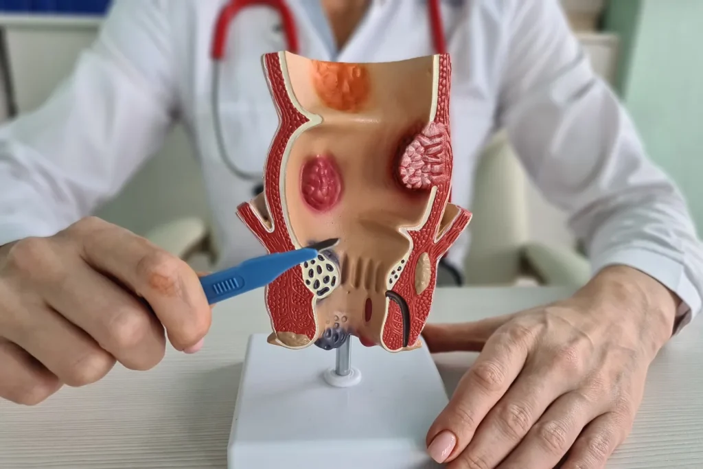 Professional Help for Hemorrhoids