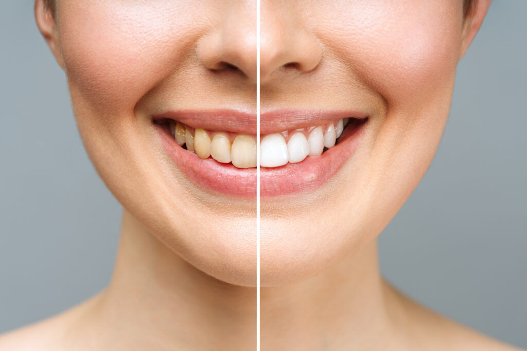 Advantages of Professional Teeth Whitening Over DIY Methods Professional Teeth Whitening
