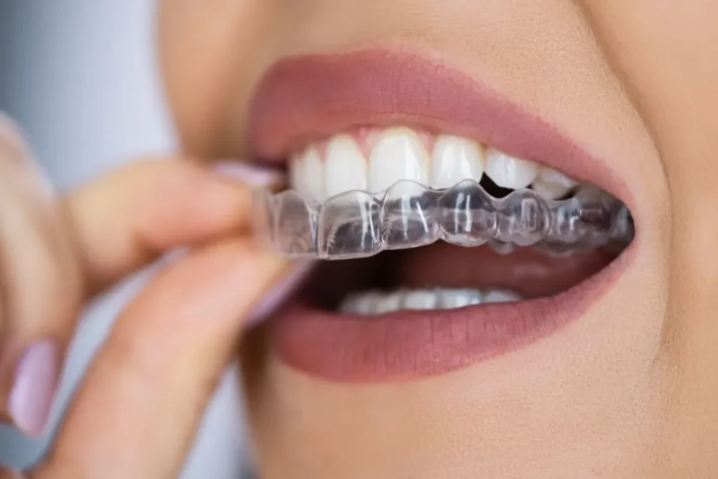 Benefits of Clear Braces