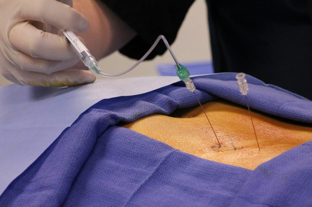Epidural Injections