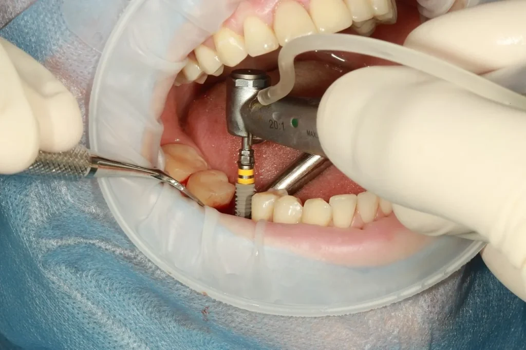 Preparing for Dental Implant Procedures