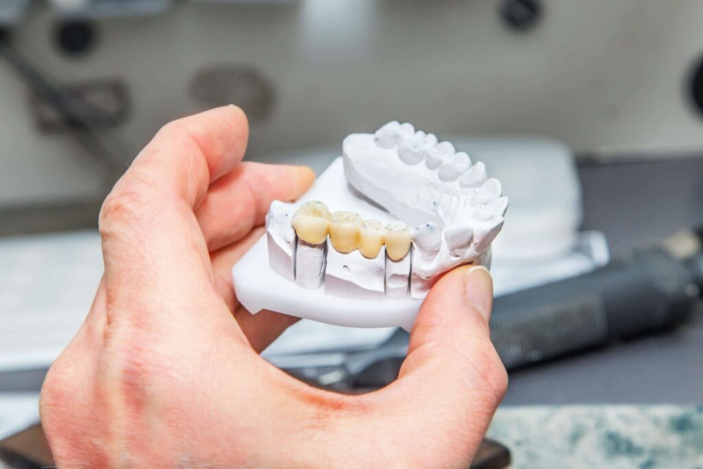 How Dental Bridges Can Improve Your Oral Health and Bite Dental Bridges