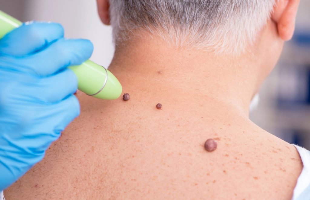 The Benefits of Dermatology in Skin Cancer Surgery Dermatology in Skin Cancer Surgery