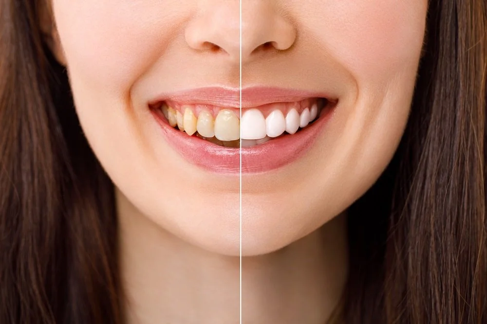 The Impact of Teeth Cleaning on Your Smile and Confidence Impact of Teeth Cleaning