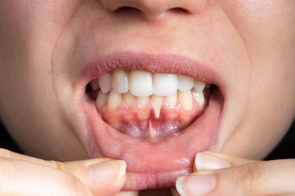 Understanding The Long-Term Effects Of Periodontal Disease Long-Term Effects Of Periodontal Disease